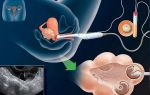 Виды выделений после эко и подсадки эмбриона